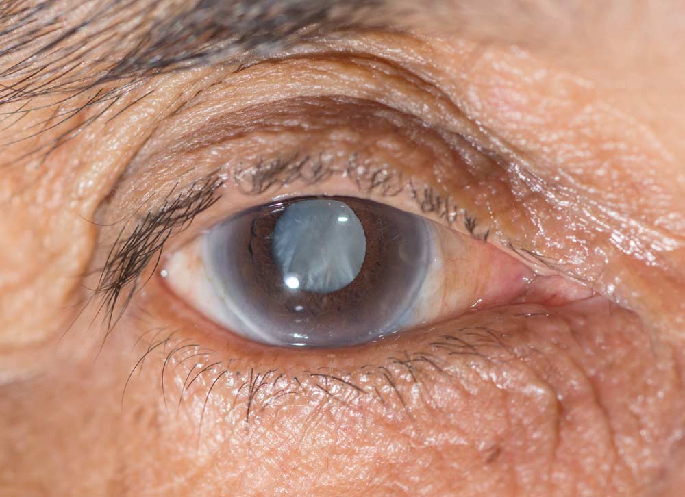 Midwest Vision Centers Cataract Awareness Month